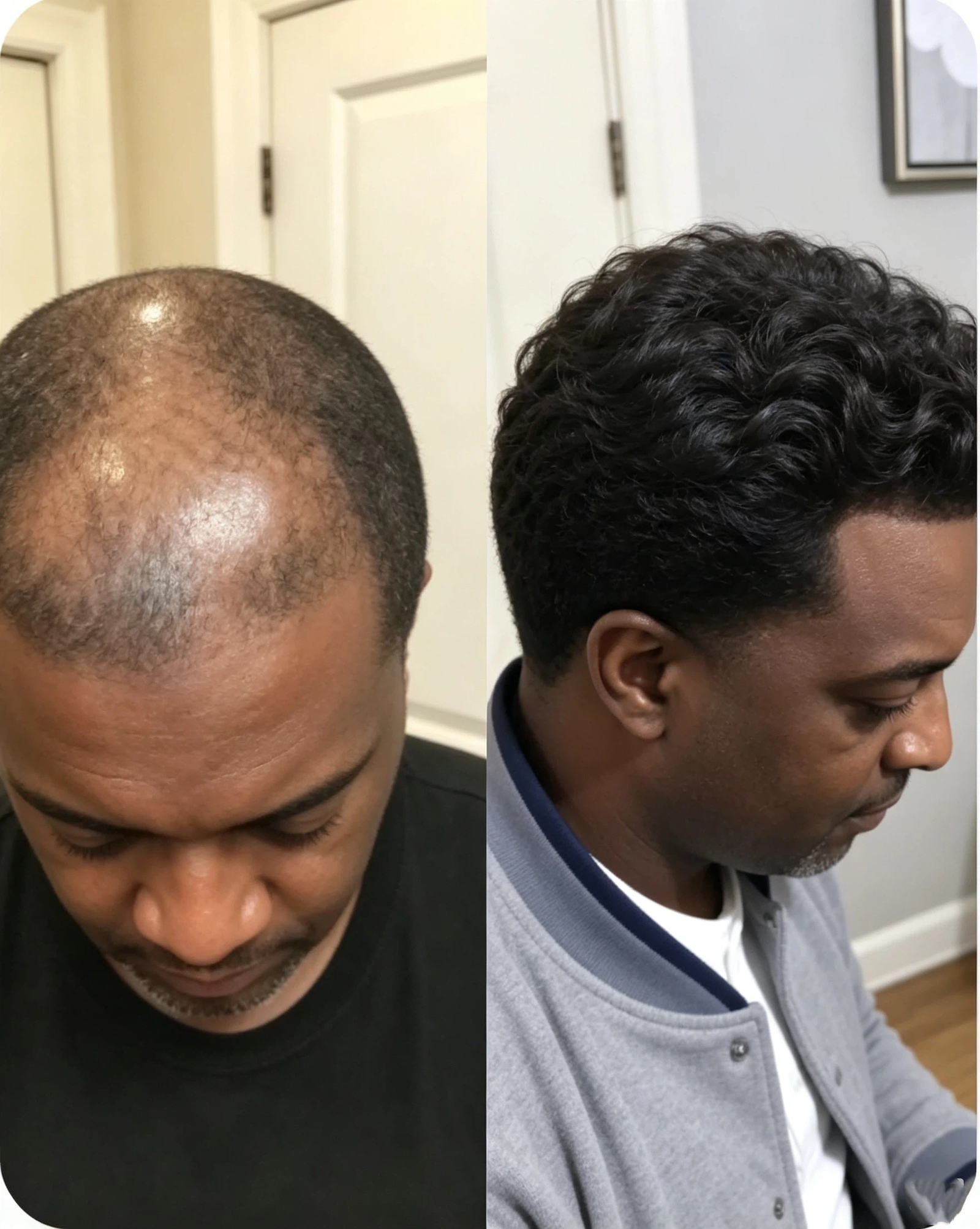 hair thinning before